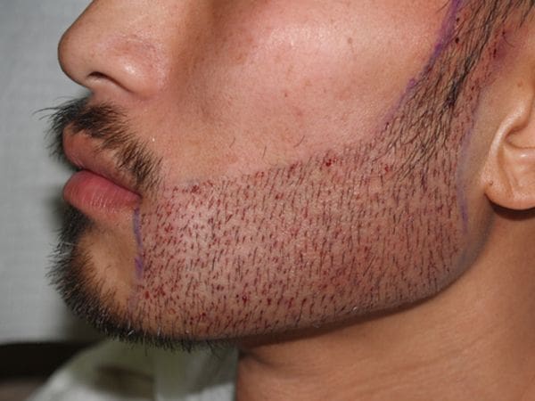 Beard Hair Transplant