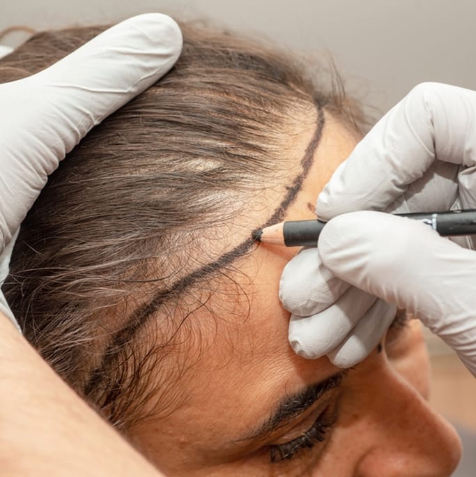 Female Hair Transplant