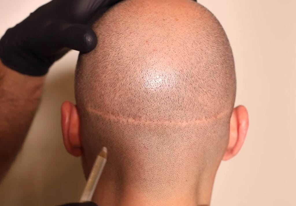 Scar Hair Transplant