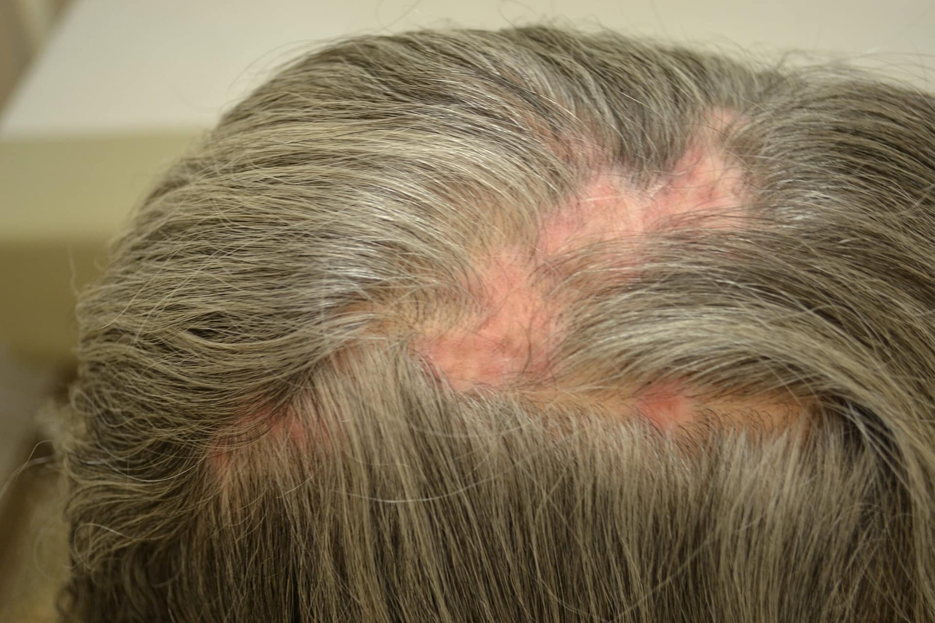 Scarring Alopecia