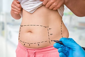 FAT LOSS LIPO 1 LIPOSUCTION.IMAGE