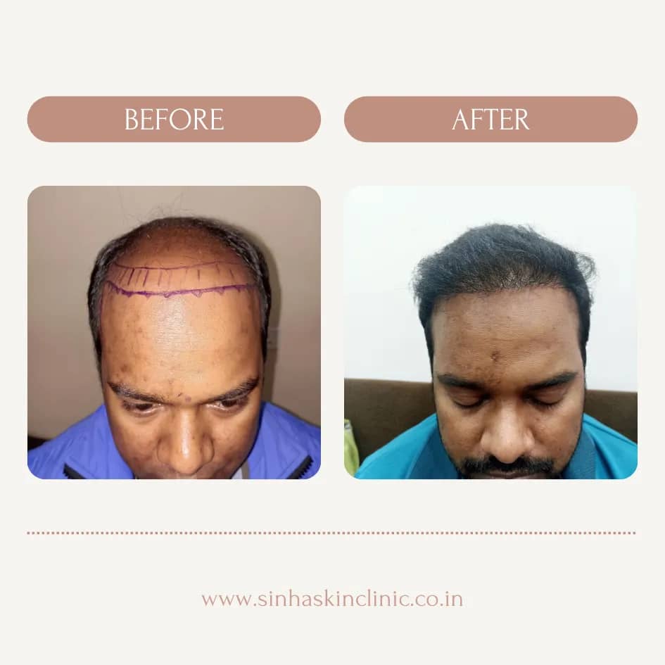 hair transplant